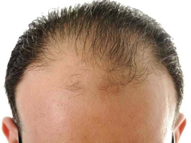 Выпадение волос у мужчин в молодом возрасте: причины и лечение облысения