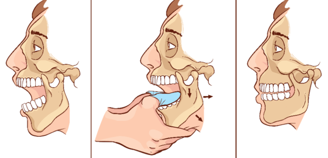 Вывих нижней челюсти: симптомы, лечение, способы вправления вывиха нижней челюсти
