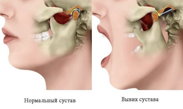 Вывих нижней челюсти: симптомы, лечение, способы вправления вывиха нижней челюсти