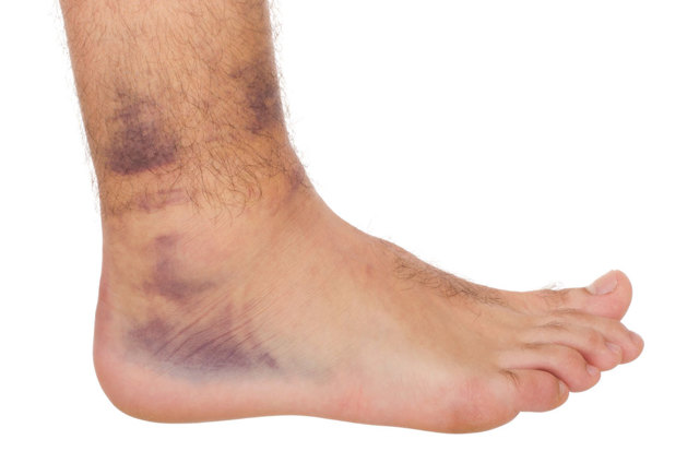 Вывих ноги в районе щиколотки: виды повреждений, характерные симптомы, методика лечения и период реабилитации