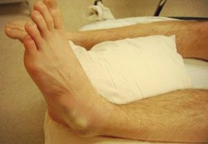 Вывих ноги в районе щиколотки: виды повреждений, характерные симптомы, методика лечения и период реабилитации