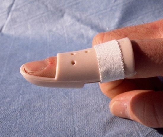 Вывих пальца на руке: типы повреждений, характерные симптомы, методы лечения, период реабилитации