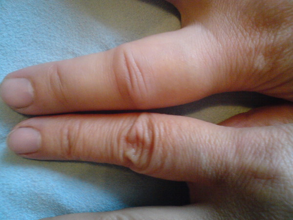 Вывих пальца на руке: типы повреждений, характерные симптомы, методы лечения, период реабилитации