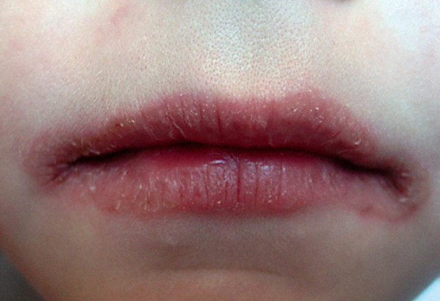 Заеды в уголках рта: фото, причины возникновения и методы лечения патологии