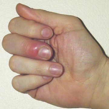 Заусенцы на пальцах: причины появления, самые эффективные методы лечения