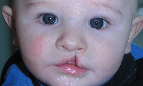 Заячья губа: причины возникновения, что делать, фото до и после операции