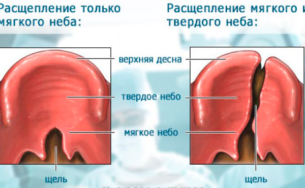 Заячья губа: причины возникновения, что делать, фото до и после операции
