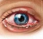 Здравствуйте! можно ли при серозном пластическом увеите глаза во время воспаления давать физические нагрузки на организм и принимать стероиды???