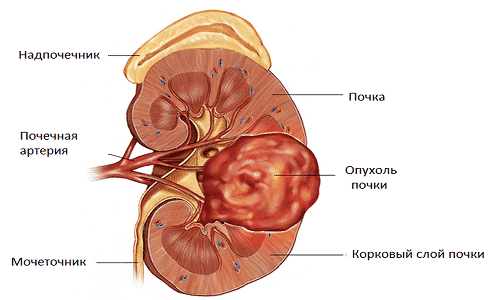 Зернисто-клеточная карцинома почки: стадии развития болезни, характерные проявления, тактика лечения и прогноз