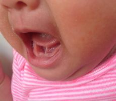 Желтый налет на языке у ребенка: провоцирующие факторы, возможные заболевания, диагностические и лечебные мероприятия