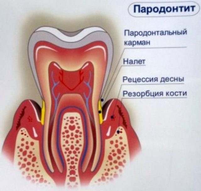 Зубная боль при гайморите: причины, медикаментозное лечение, список антибиотиков