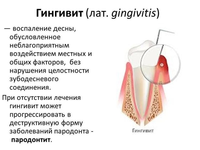 Зубная боль при гайморите: причины, медикаментозное лечение, список антибиотиков