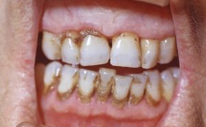 Зубной камень: провоцирующие факторы, симптомы появления, методы удаления в стоматологии и в домашних условиях