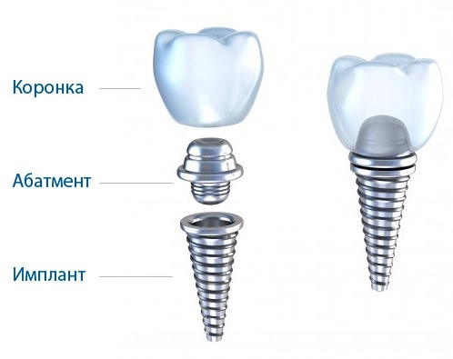 Зубные имплантаты: преимущества и недостатки, показания и противопоказания к установке