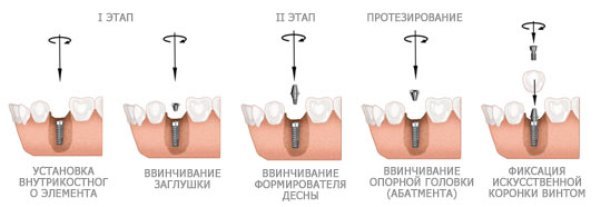 Зубные имплантаты: преимущества и недостатки, показания и противопоказания к установке
