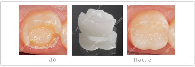 Зубные вкладки в стоматологии: что это такое, виды, материалы, процесс установки