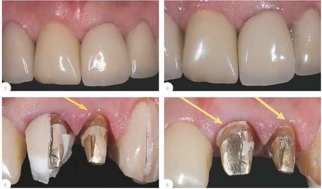 Зубные вкладки в стоматологии: что это такое, виды, материалы, процесс установки