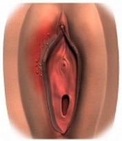 Зуд половых органов: обследования гениталий и возможные причины появления сыпи