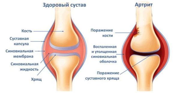 Артрит коленного сустава: что это такое, виды и описание болезни, причины появления, симптомы, диагностика и лечение