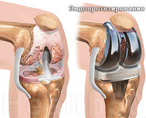 Артроз коленного сустава: симптомы, причины, диагностика и лечение в домашних условиях