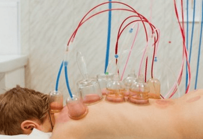 Баночный массаж при остеохондрозе позвоночника, вакуумный массаж спины: польза и вред, особенности подготовки, возможные последствия, отзывы