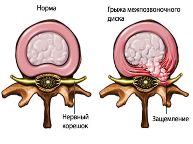 Цервикокраниалгия на фоне шейного остеохондроза: что это такое, особенности диагностики и терапии заболевания, профилактика и рекомендации