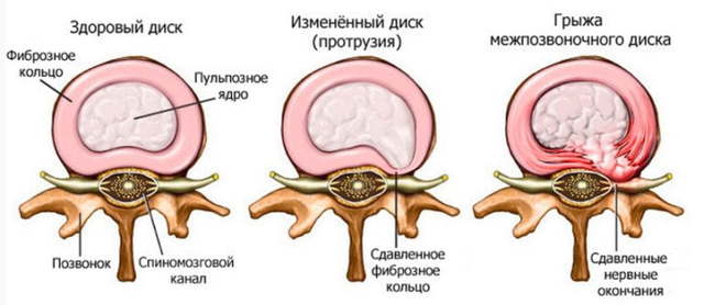 Диагностика остеохондроза: основные причины, симптоматика, исследование и лечение заболевания