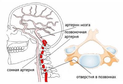 Головная боль при остеохондрозе шейного отдела: почему возникает, о чем говорит симптом, диагностика и лечение