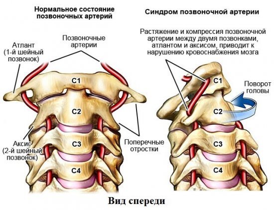 Головокружение при остеохондрозе шейного отдела позвоночника: почему возникает, о чем говорит симптом, диагностика и лечение
