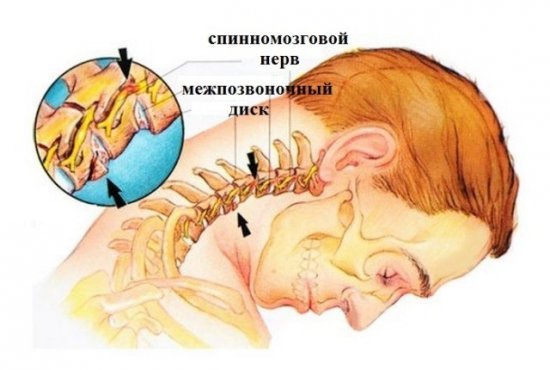 Головокружение при остеохондрозе шейного отдела позвоночника: почему возникает, о чем говорит симптом, диагностика и лечение