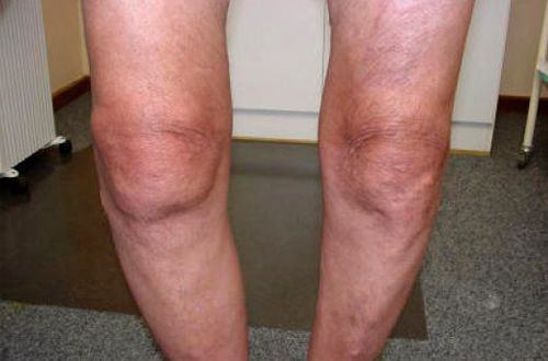 Гонартроз коленного сустава - что это: как проявляет себя болезнь, диагностика, хирургическое лечение и восстановительный период после операции