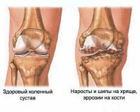 Гонартроз коленного сустава - что это: как проявляет себя болезнь, диагностика, хирургическое лечение и восстановительный период после операции