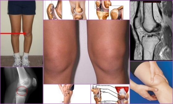Хондромаляция надколенника, коленного сустава: что это, как развивается патология, виды заболеваний, возможные осложнения и способы лечения