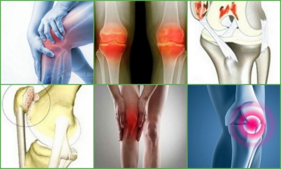Хондромаляция надколенника, коленного сустава: что это, как развивается патология, виды заболеваний, возможные осложнения и способы лечения