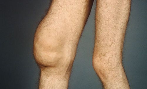Хондроматоз коленного сустава - что это, лечение, синовиальный - Сайт об остеохандрозе
