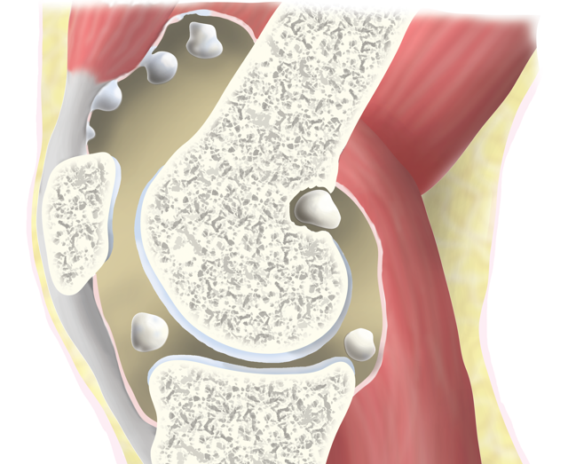 Хондроматоз коленного сустава - что это, лечение, синовиальный - Сайт об остеохандрозе