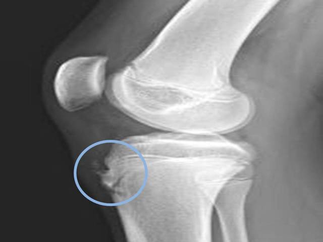 Хондропатия коленного сустава: что это такое, как проявляется, диагностика, особенности лечения надколенника
