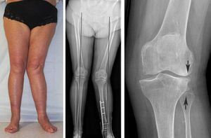 Хондропротекторы при артрозе коленного сустава: что это, особенности назначения медикаментов, механизм действия, когда назначают, отзывы