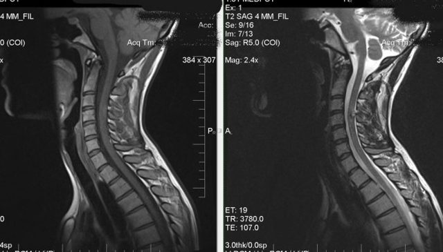 Как диагностировать остеохондроз позвоночника: инструментальные методы диагностики, рентгенологическое исследование и лечение