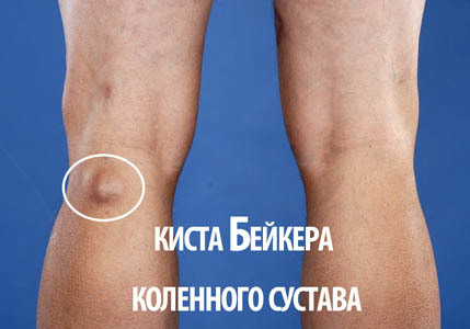 Киста Бейкера коленного сустава: что это, как проявляется, диагностика и лечение, прогноз врачей на выздоровление