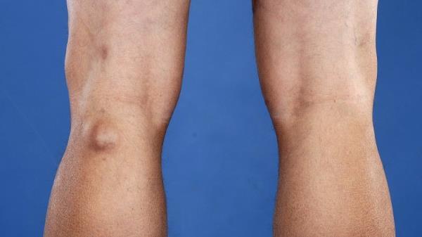 Киста Бейкера коленного сустава: что это, как проявляется, диагностика и лечение, прогноз врачей на выздоровление