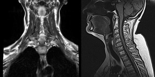 Ком в горле при остеохондрозе шейного отдела: основные причины и симптомы, диагностика болезни и лечение комка