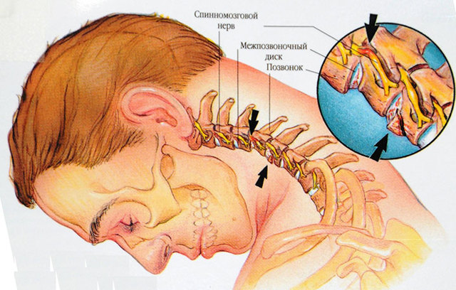 Компресс на шею при остеохондрозе: особенности применения и противопоказания, эффективность, рекомендации специалистов