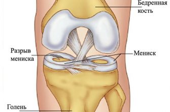 Мениск коленного сустава: что это такое, основные причины, симптомы, диагностика, лечение и профилактические меры