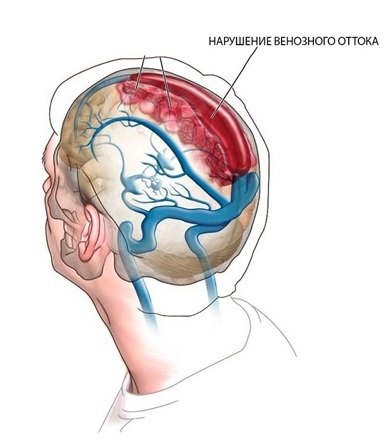 Нарушение венозного оттока головного мозга: как проявляется, особенности диагностики и лечения заболевания