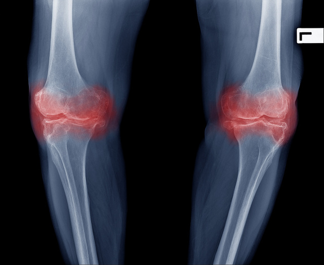 Остеоартроз суставов: - что это, как проявляется, методы диагностики и лечения, особенности профилактики, рекомендации врачей