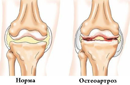 Остеоартроз суставов: - что это, как проявляется, методы диагностики и лечения, особенности профилактики, рекомендации врачей