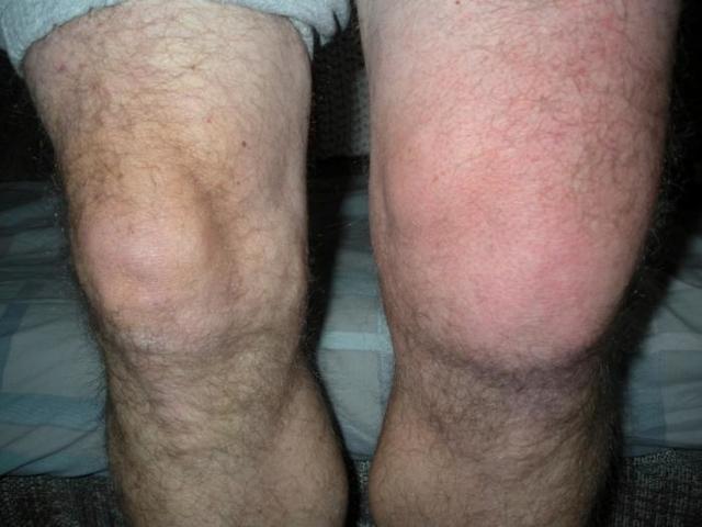 Остеохондроз коленного сустава (ОКС): почему развивается болезнь, симптомы, диагностика, принципы лечения патологии