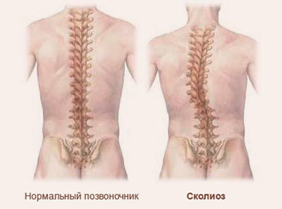 Остеохондроз шейно грудного отдела: клинические проявления, причины болей, диагностика и лечение