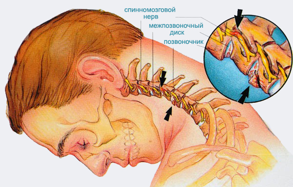 Остеохондроз шейного отдела позвоночника: основные причины, как проявляется, диагностика и лечение